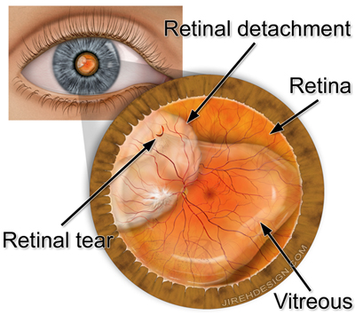 Retinal Tear Symptoms Nhs
