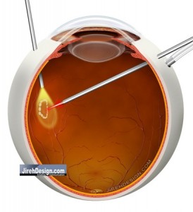 Vitrectomy for Retinal Tear to Remove Vitreous Hemorrhage