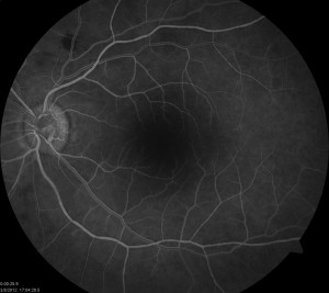 Fluorescein Angiogram is a diagnostic test used by retina specialists.
