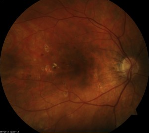 Diabetic macular edema after laser treatment.