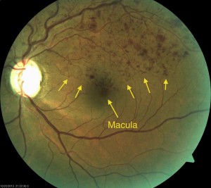Branch Retinal Vein Occlusion with almost no macular edema.