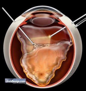 Vitrectomy for repair of retinal detachment