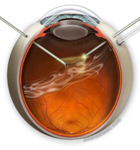 Vitrectomy is performed by retina specialists to repair various retinal diseases.  Randall Wong, M.D.