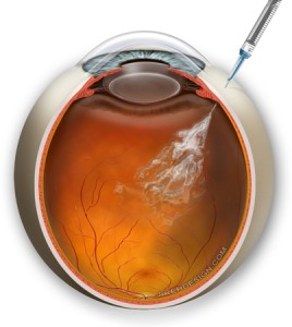 Intraocular Injection, Randall V. Wong, M.D., Retina Specialist, Fairfax, Virginia