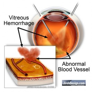 Vitrectomy Surgery to Clear Hemorrhage