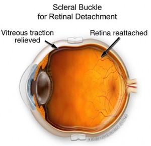 Scleral Buckle for Repair of Retinal Detachment