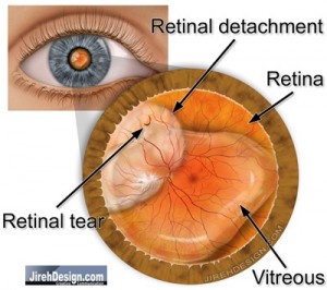 Retinal detachment, Randall Wong, M.D., Fairfax, Virginia