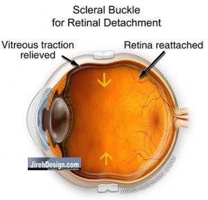 A Scleral Buckle is Placed to Repair a Retinal Detachment