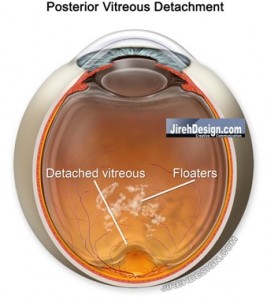 A Posterior Vitreous Detachment May Cause a Retinal Tear
