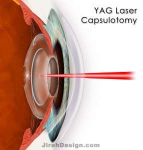 YAG Laser Used for Posterior Capsulotomy