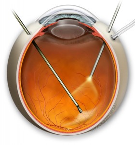 Surgery for Macular Pucker. Randall V. Wong, M.D., Retina Specialist, Fairfax, Virginia.