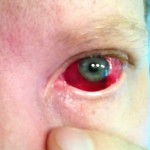 Subconjunctival hemorrhage looks frightening but is really quite benign. It doesn't even hurt. Randall Wong, M.D., Retina Specialist, Fairfax, VA 22030