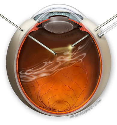 Vitrectomy is performed by retina specialists to repair various retinal diseases. Randall Wong, M.D.