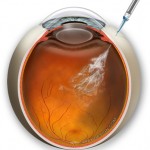 Intraocular Injection, Randall V. Wong, M.D., Retina Specialist, Fairfax, Virginia