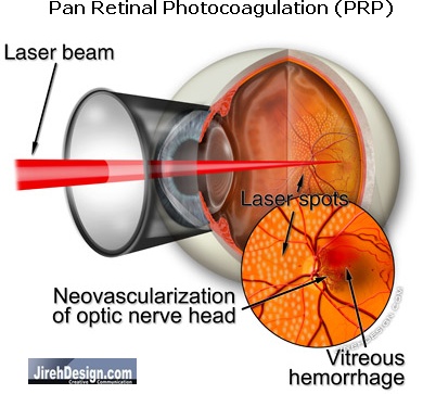 Pan Retinal Photocoagulation (PRP) Used to Treat Proliferative Diabetic Retinopathy