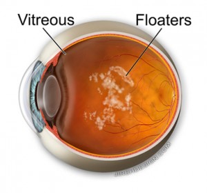 Vitrectomy for the removal of Floaters, Randall Wong, M.D.