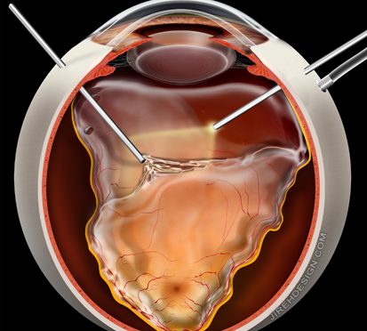 Vitrectomy for Retinal Detachment