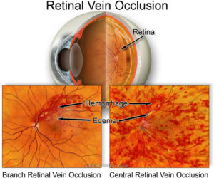 Central Retinal Vein Occlusions | Randall Wong MD Retina Specialist