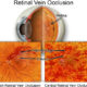 Central Retinal Vein Occlusions | Randall Wong MD Retina Specialist