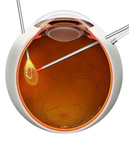 Article Image Vitrectomy to Treat Retinal Tear | Retina Specialist | Randall Wong MD