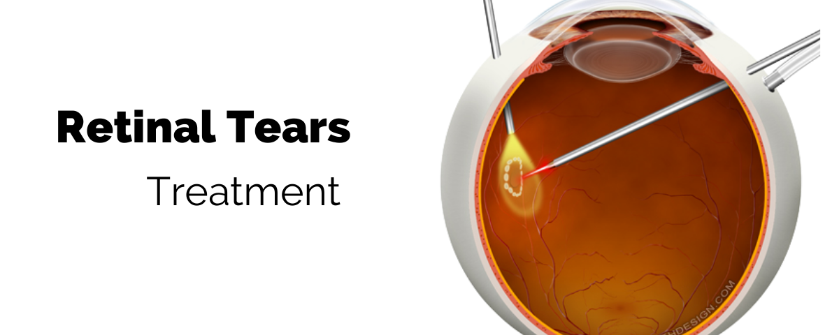 Featured Image Retinal Tears Treatment | Randall Wong MD | Retina Specialist