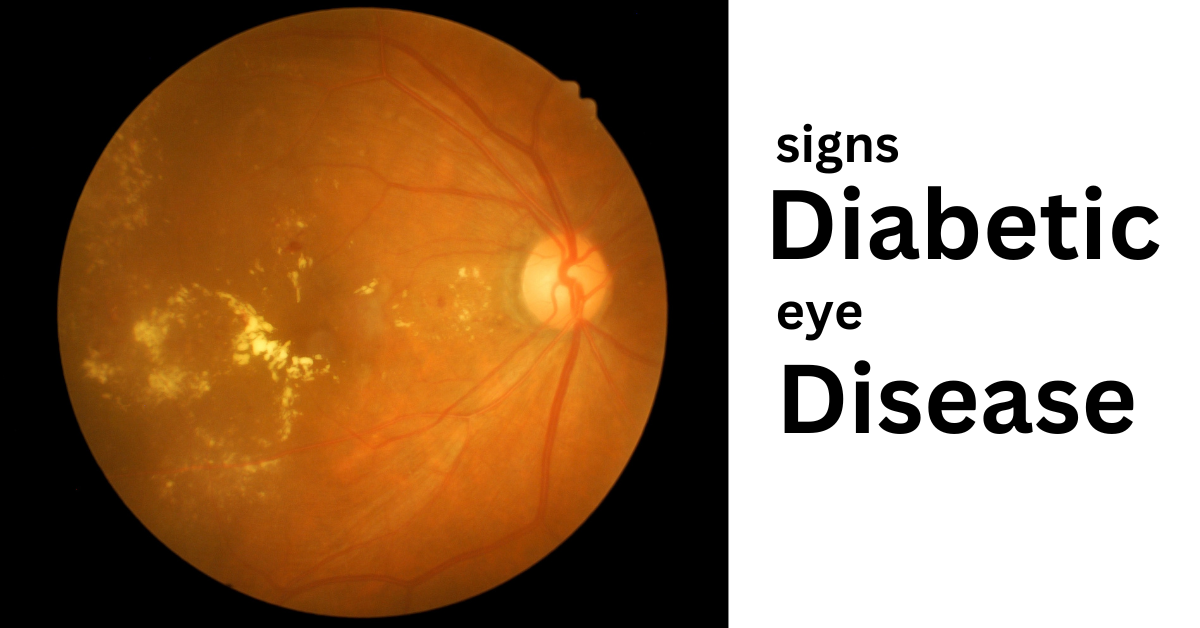 Featured Image of Diabetic Eye Disease